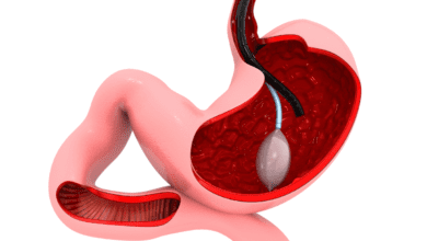 Gastric balloon pill