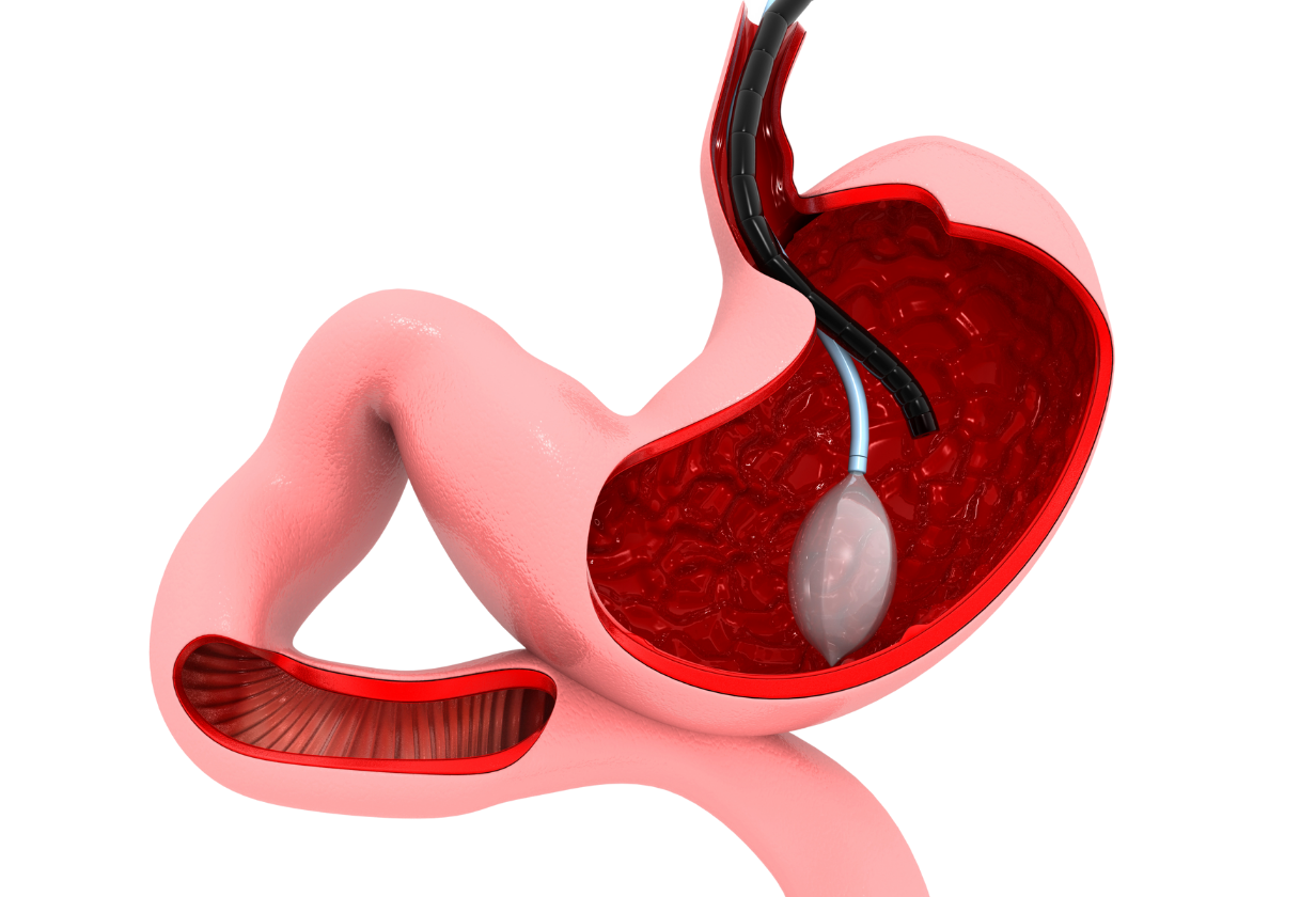 Gastric balloon pill