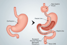 Medical diagram illustrating gastric sleeve surgery, showing the normal stomach next to the reduced, restrictive sleeve that remains after the procedure.