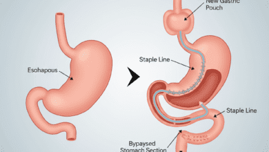 Medical diagram illustrating gastric sleeve surgery, showing the normal stomach next to the reduced, restrictive sleeve that remains after the procedure.