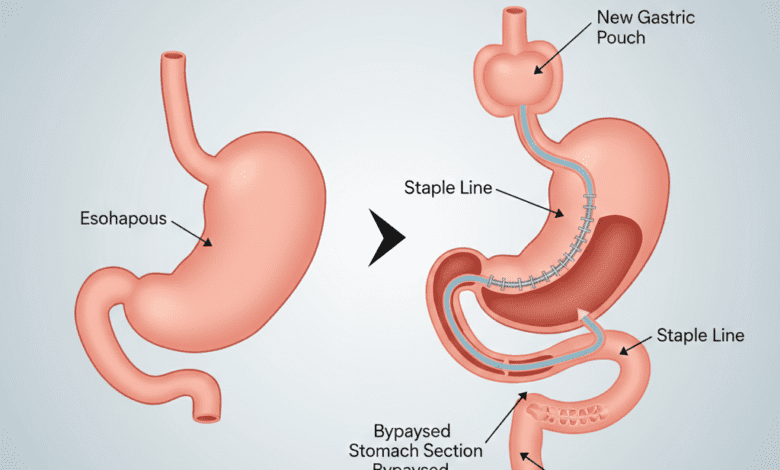 Medical diagram illustrating gastric sleeve surgery, showing the normal stomach next to the reduced, restrictive sleeve that remains after the procedure.
