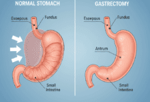Medical diagram illustrating gastric sleeve surgery, showing the normal stomach next to the reduced, restrictive sleeve that remains after the procedure.