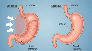Medical diagram illustrating gastric sleeve surgery, showing the normal stomach next to the reduced, restrictive sleeve that remains after the procedure.