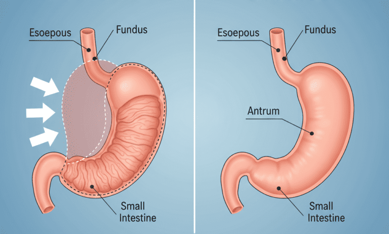 Medical diagram illustrating gastric sleeve surgery, showing the normal stomach next to the reduced, restrictive sleeve that remains after the procedure.