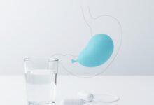 An illustration of the Elipse swallowable gastric balloon in both its pill-sized capsule form and its inflated state within the stomach.