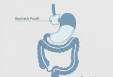 A professional medical diagram illustrating the anatomical changes of a roux en y gastric bypass surgery.
