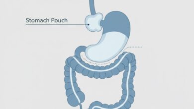 A professional medical diagram illustrating the anatomical changes of a roux en y gastric bypass surgery.