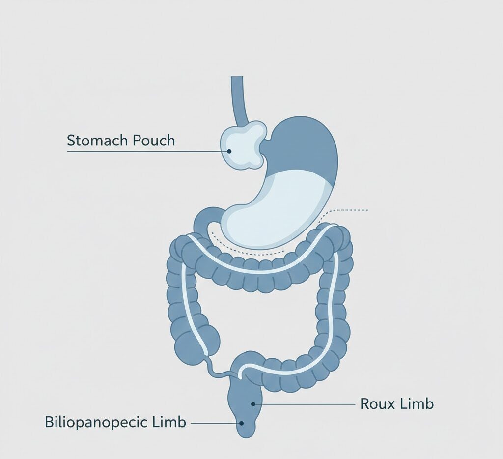 A professional medical diagram illustrating the anatomical changes of a roux en y gastric bypass surgery.