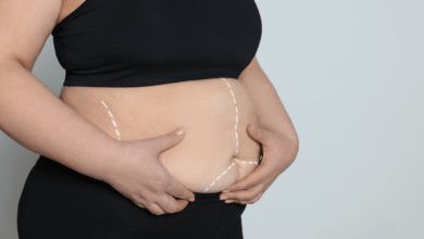 Bariatric surgery