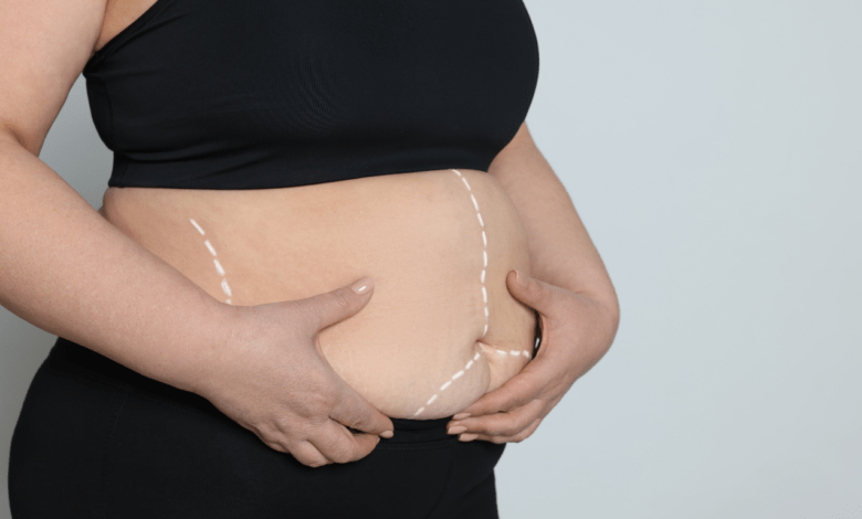 Bariatric surgery