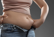 Gastric band