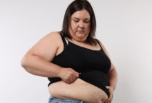 Weight loss surgery